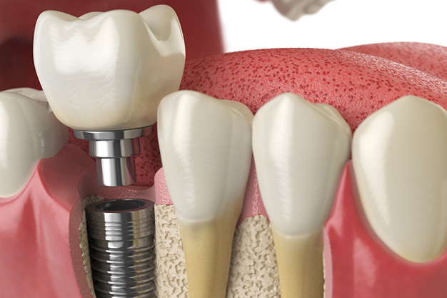 Cuántos tipos de implantes existen