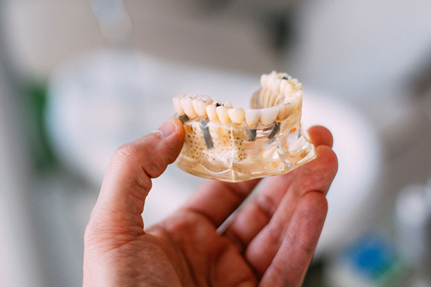Debo colocarme un implante dental inmediato