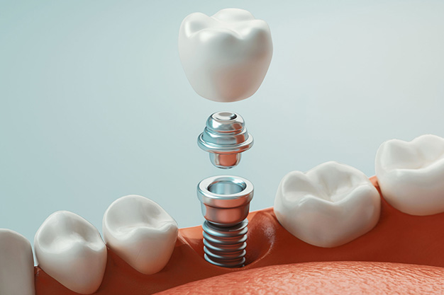Pros y contras de los implantes dentales inmediatos
