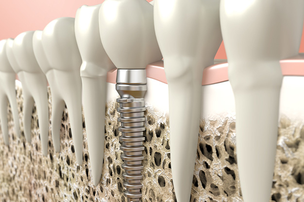 Importancia de la osteointegración