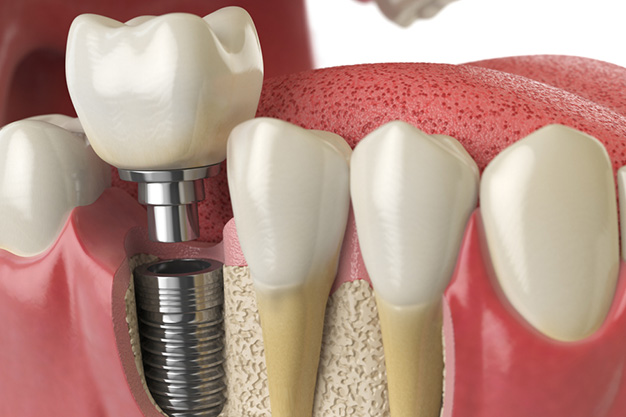 Inconvenientes en el proceso de osteointegración