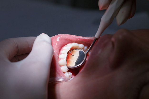Por qué se produce la gingivitis
