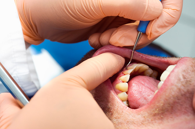 Qué ocurre si no tratamos la periodontitis