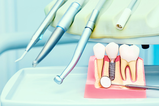 Colocación de un implante dental sin dolor
