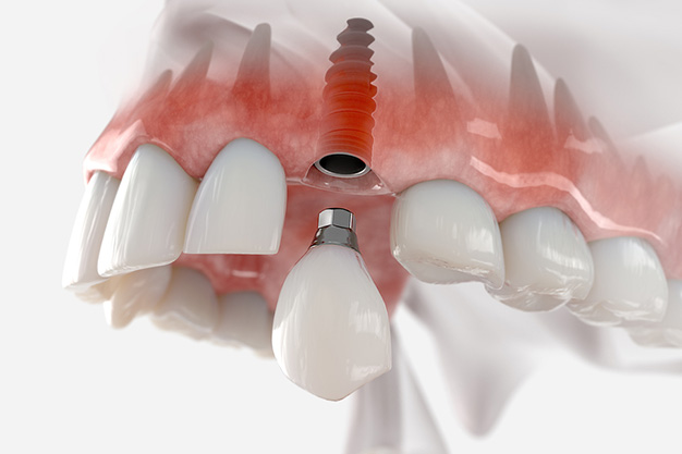 Pueden surgir complicaciones al colocar un implante dental