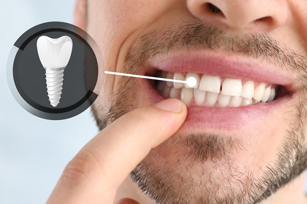 Qué ocurre si necesito un implante dental y no me lo pongo