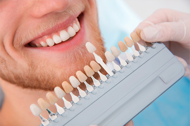 Importante antes de hacer un blanqueamiento dental