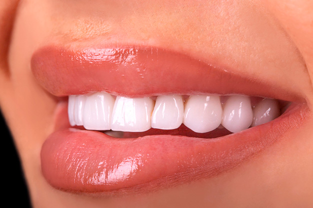 Mantenimiento de un blanqueamiento dental