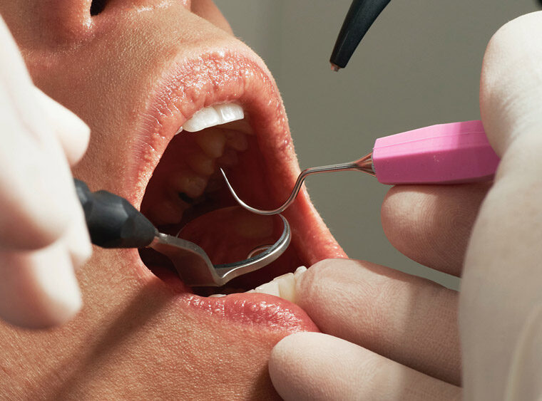 Efectos-de-vapear-en-nuestra-salud-bucodental