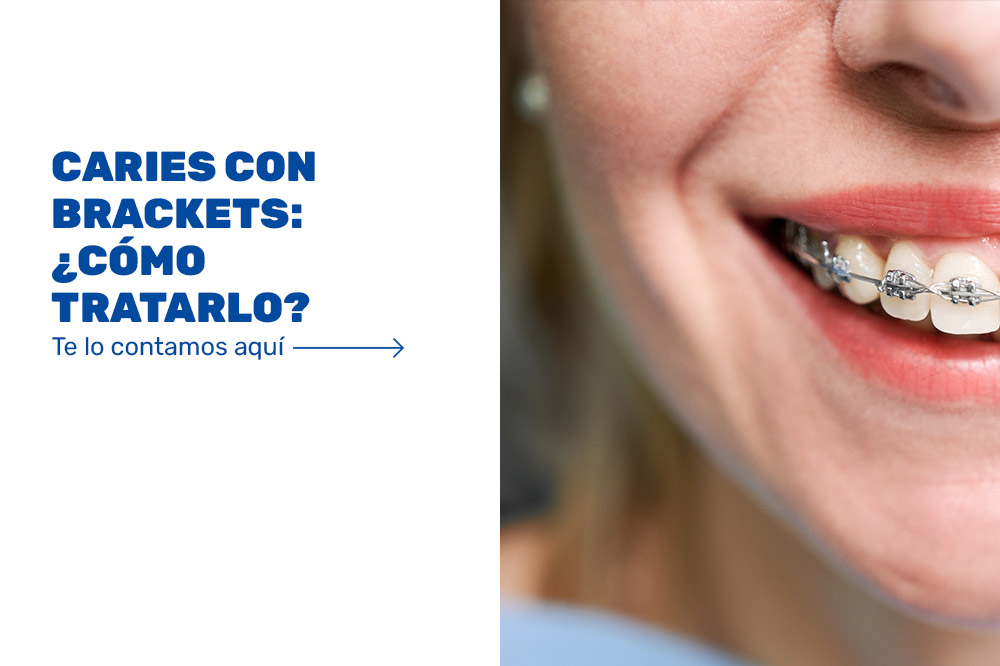 Caries con brackets ¿Cómo tratarlo? DUELINE · Clínica Dental en Alicante