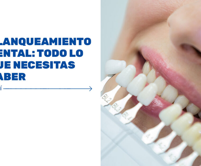 Blanqueamiento-dental---todo-lo-que-necesitas-saber