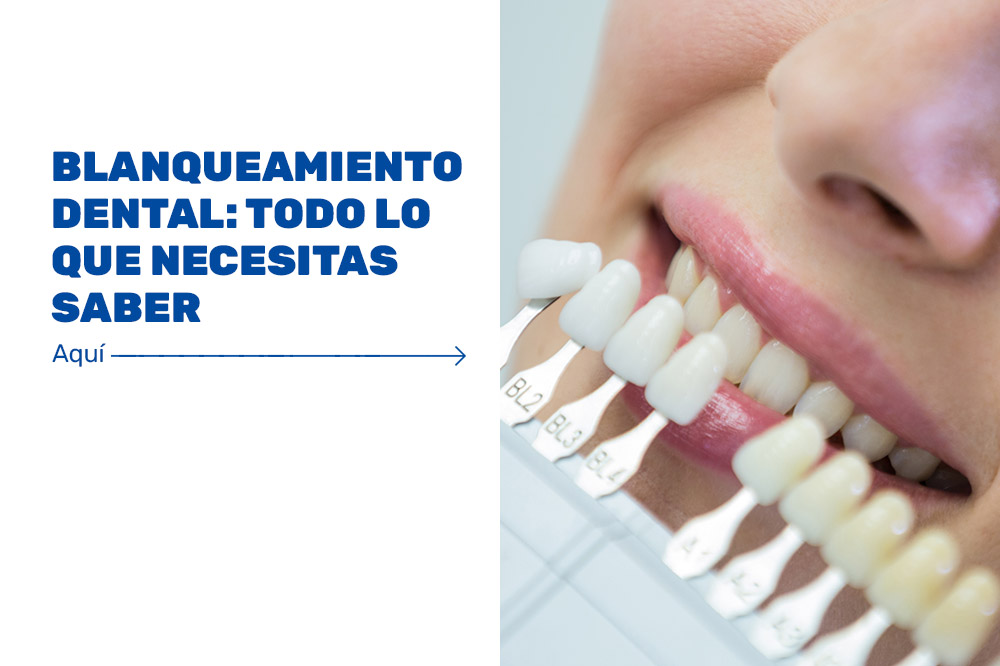 Blanqueamiento-dental---todo-lo-que-necesitas-saber