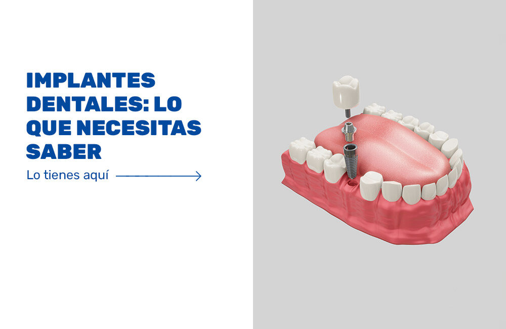 Implantes-dentales---lo-que-necesitas-saber