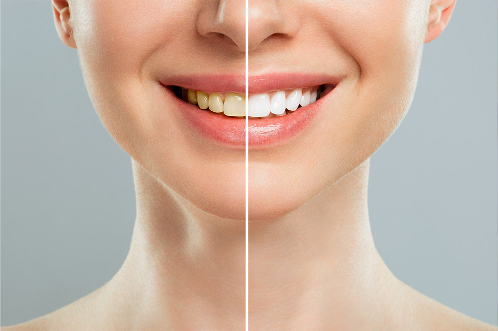 Qué-un-blanqueamiento-dental