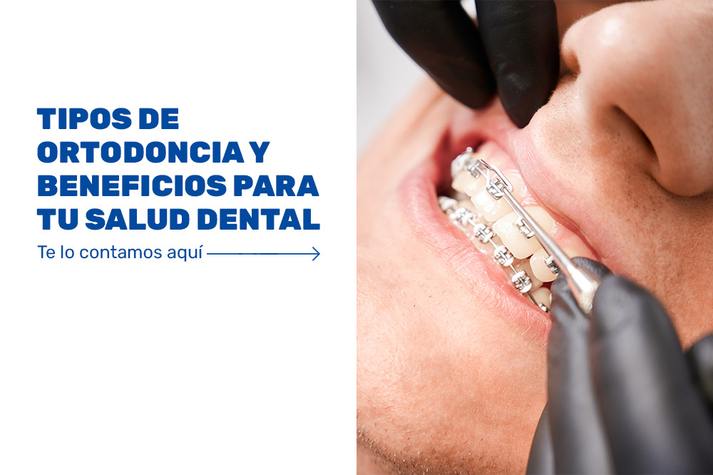 Tipos-de-ortodoncia-y-beneficios-para-tu-salud-dental